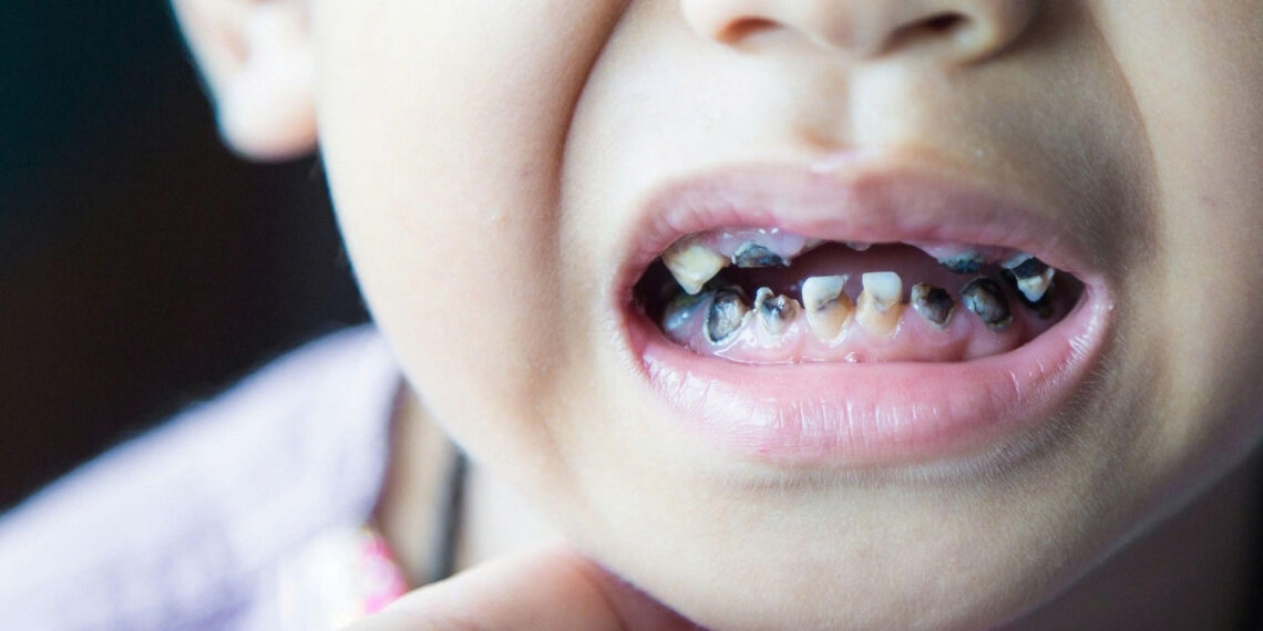 4 ly do khien tre ngay nay bi sau rang sua som hon truoc 301.jpeg