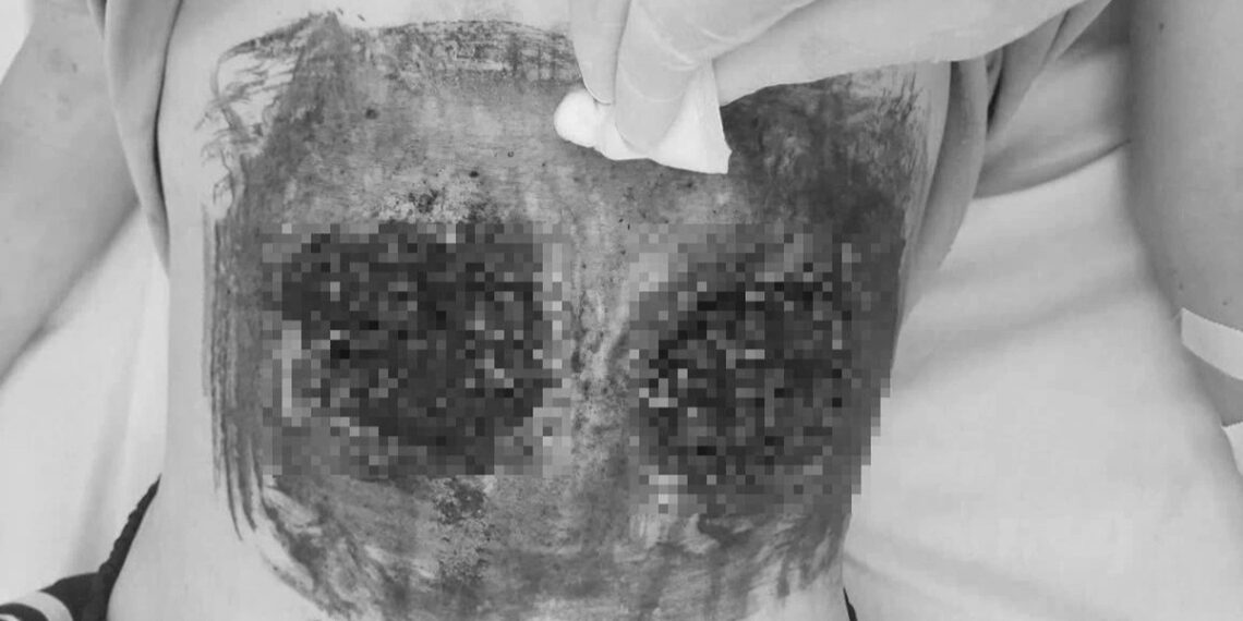 Cô gái bỏng nặng vì giác hơi bụng để... chữa ung thư co gai bong nang vi giac hoi bung de crop 1727672610602.jpeg