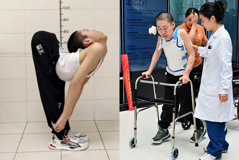 Chàng trai cột sống cong hình chữ Z tập đi sau 20 năm gaplung1 1756692046 2591 1756692338.jpg