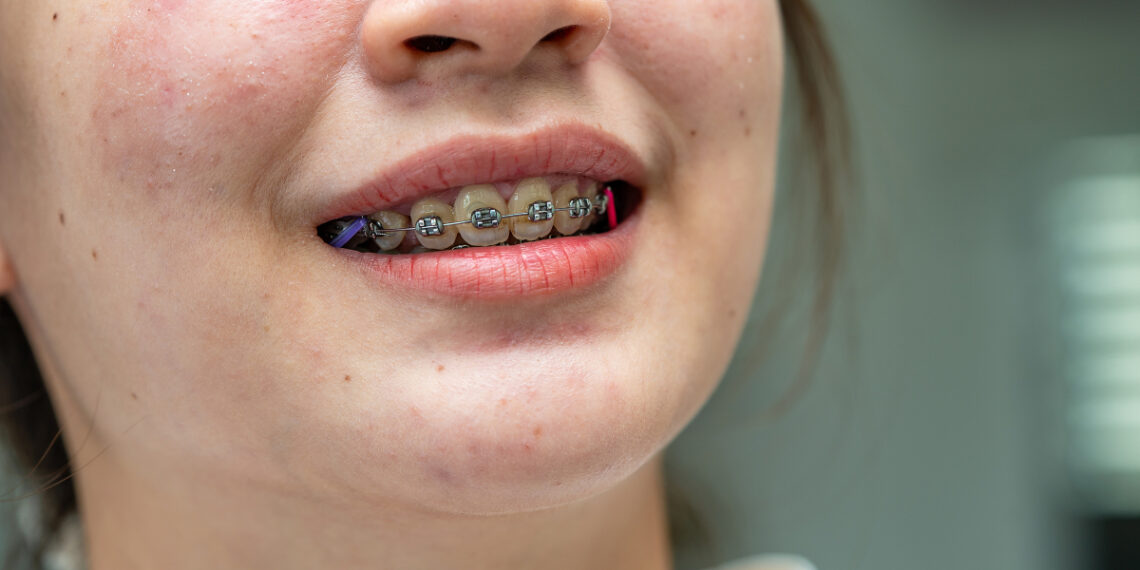 large vecteezy braces in teena 9142 7568 1757403256.jpg