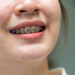 large vecteezy braces in teena 9142 7568 1757403256.jpg