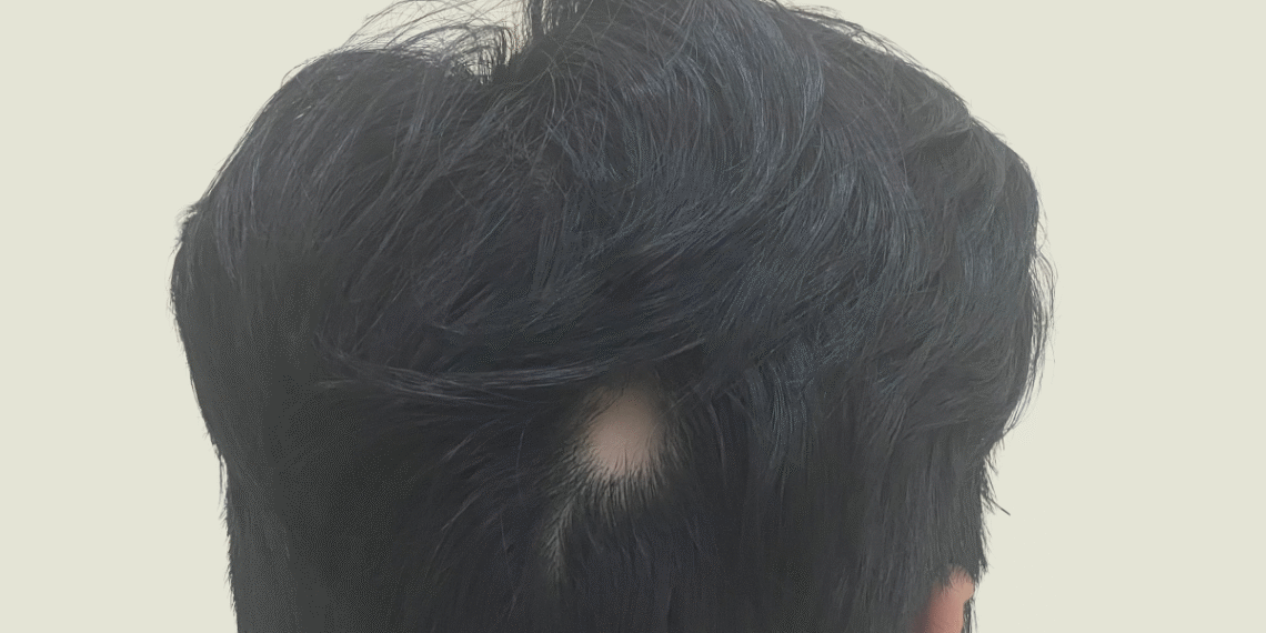 Hói đầu ở tuổi 17 ma ng ho i 1756393952 17563940 2295 4767 1756394248.png