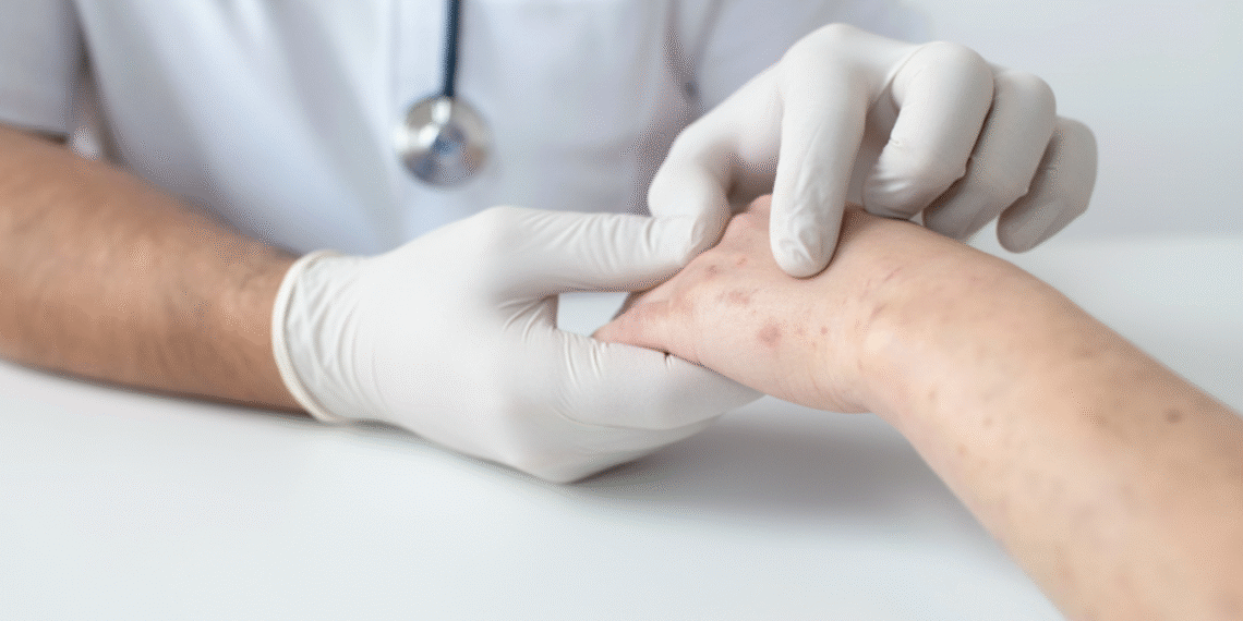 Nhận biết mụn cóc do HPV gây ra screenshot 2025 09 21 at 00 59 4969 6345 1758391272.png