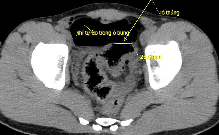 Thủng đại tràng do vòi xịt nước áp lực cao 2 21 1760925420 1760925550 5919 1760925559.jpg