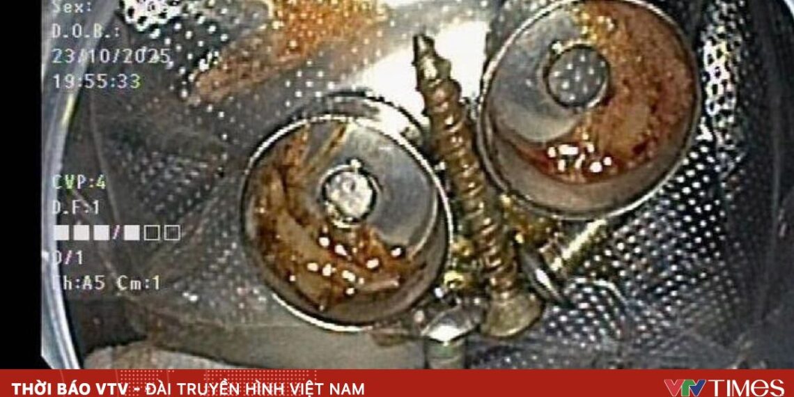 Gắp hàng chục đinh và ốc vít ra khỏi dạ dày người đàn ông 35 tuổi