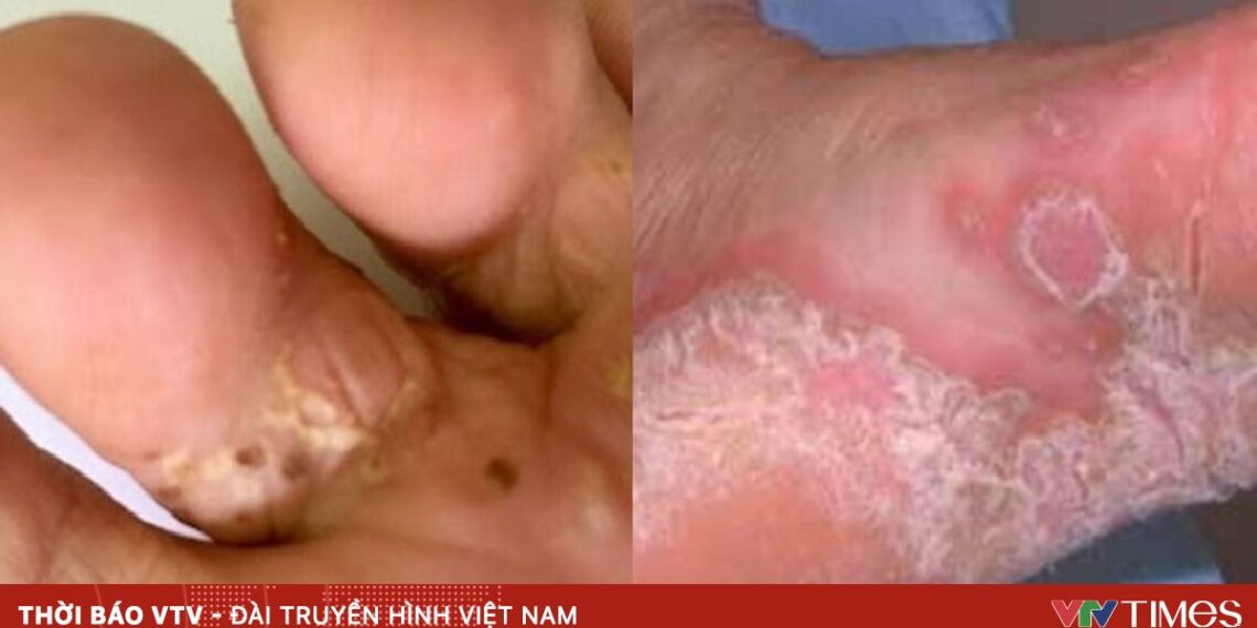 Sốt và bệnh da liễu gia tăng sau bão lũ: Khuyến cáo cẩn trọng khi dọn dẹp môi trường benh da mua mua lu 50473594783240308371696 33990911138303099217236.jpg