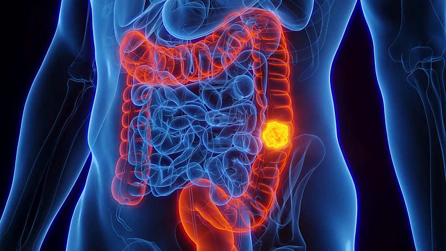 Phát hiện hai loại ung thư từ triệu chứng đau bụng colon cancer descending colon 6688 2146 1759629167.png