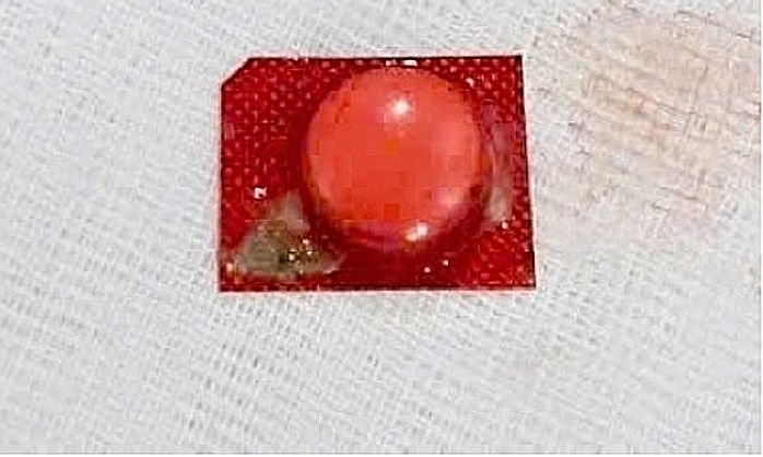 Viên thuốc nguyên vỉ kẹt trong phế quản người đàn ông image002 1759712141 1759712164 3100 4338 1759712291.jpg