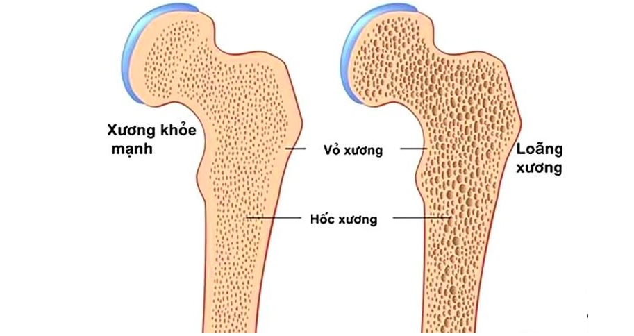 Loãng xương tiến triển âm thầm nhchpmnhnh20251019lc175307 176 1614 8434 1760871226.png