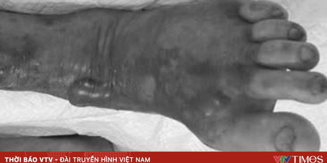 Cảnh báo nguy cơ nhiễm vi khuẩn "ăn thịt người" từ nước biển và hải sản sống package media 03305471112055219921895 29796754197062538564844.png