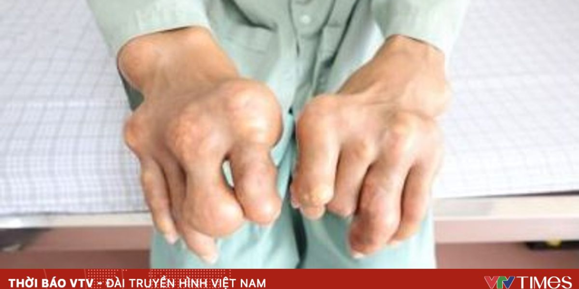 Tự điều trị gout, bị biến chứng nặng package media 28902282930840793967426 65953162437996877038164.png