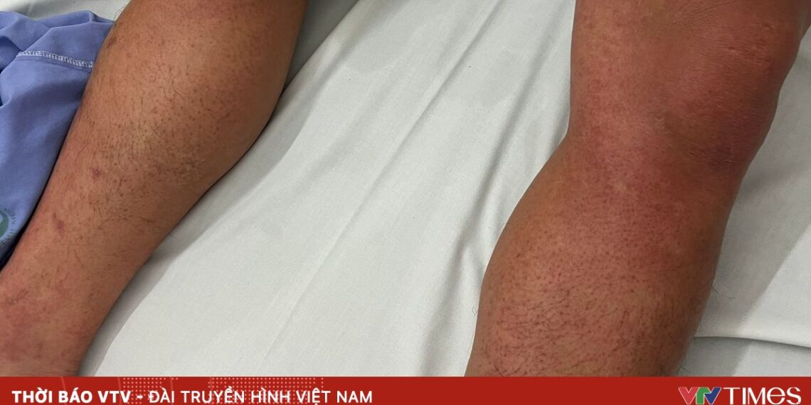 benh nhan sot xuat huyet ha noi 45297864960370340430757 08407338142864384996916.jpg