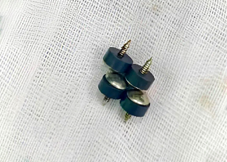 Bé 2 tuổi nuốt 4 đinh nam châm dinhnamcham 1764148314 9689 1764148567.jpg