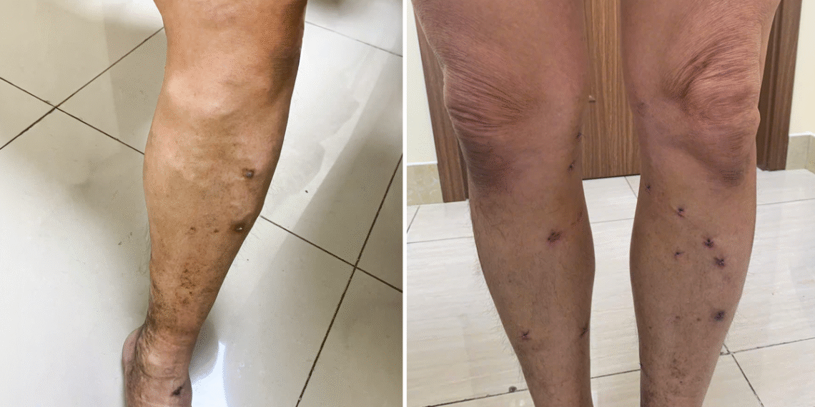 Dấu hiệu suy giãn tĩnh mạch chân không nên bỏ qua suy ti nh ma ch chi du o i 176 6384 8480 1764042521.png