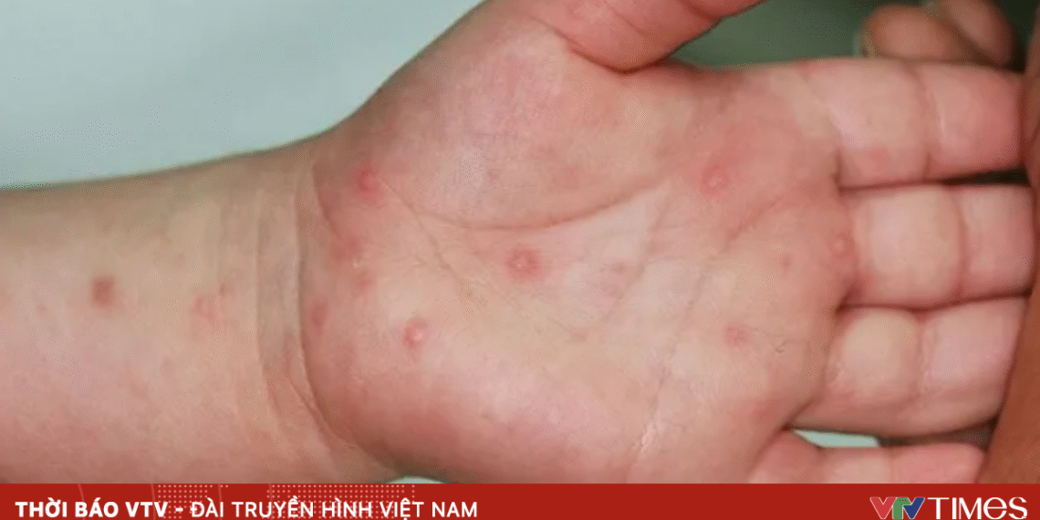 tay chan mieng 14 3 2025 43397402862283208848607 52263131903660499508058 69892368180085071211566.png