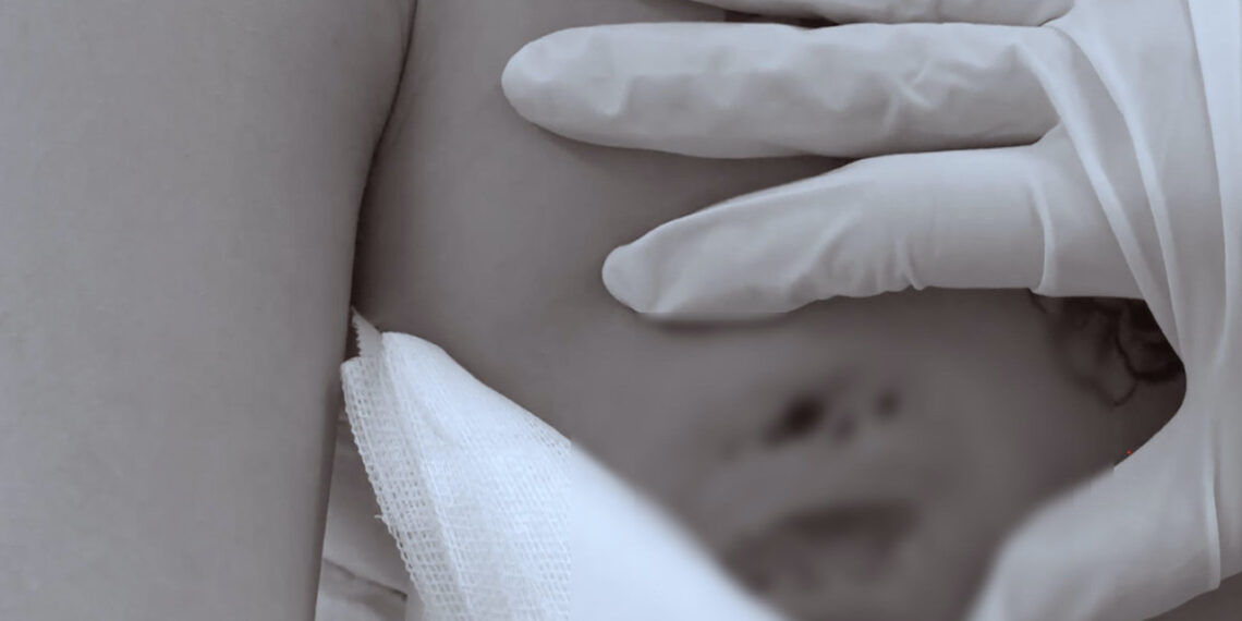 Cô gái nhập viện vì áp xe nặng sau tiêm filler nâng vòng một co gai nhap vien vi ap xe nang sau tiem filler nang vong mot 1087.jpg