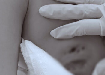 co gai nhap vien vi ap xe nang sau tiem filler nang vong mot 1087.jpg