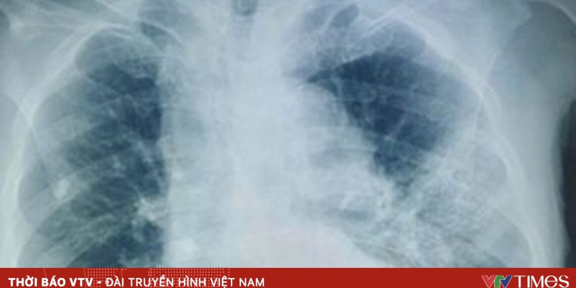 nam phoi 00879418714950869362540 78970696509788675702565.jpg