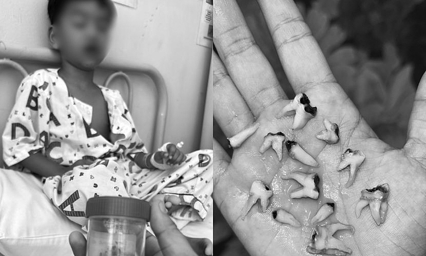 Nhổ 12 răng sâu cùng lúc vì thói quen ngậm bình sữa khi ngủ rang3 1765160403 1765160424 1226 1765160438.jpg