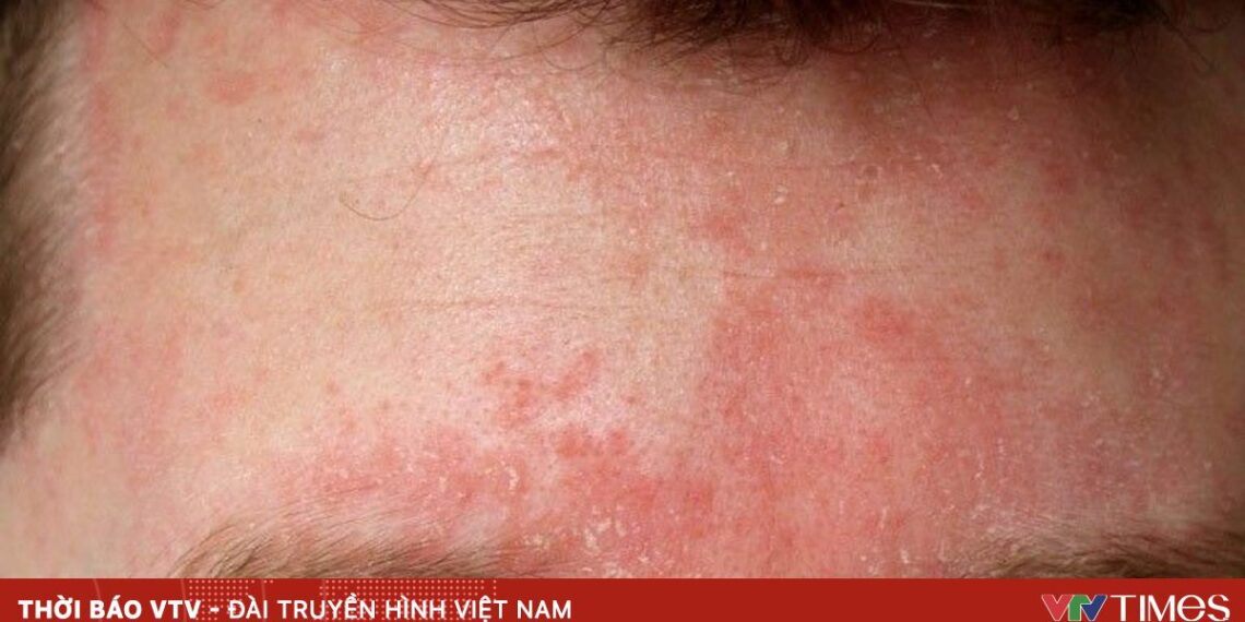 Những bệnh da thường gặp trong mùa lạnh benh da 27053284596849438678354 76969915092295792183088.jpg