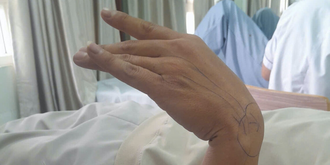 tinh day sau giac ngu gat nam nhan vien van phong bat ngo liet ban tay 1813.jpeg