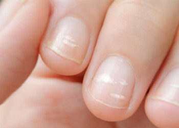 tren tay xuat hien 5 thay doi coi chung la tin hieu ung thu 1967.jpg