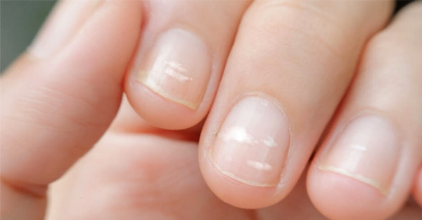 tren tay xuat hien 5 thay doi coi chung la tin hieu ung thu 1967.jpg