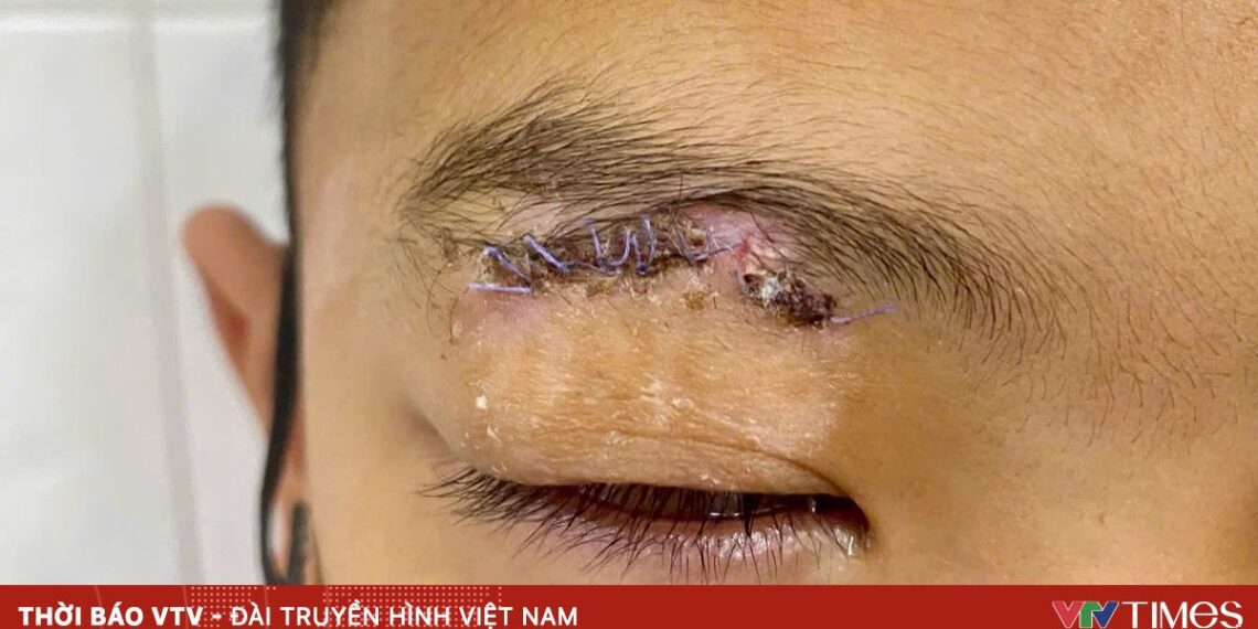 chan thuong mat do phao 31825871968490809239421 31947289322196030305646.jpg