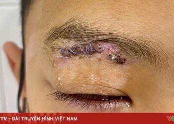 Nhiều trẻ chấn thương mắt do pháo dịp Tết chan thuong mat do phao 31825871968490809239421 31947289322196030305646.jpg