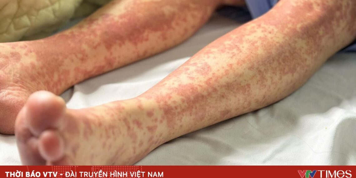 Đừng chủ quan với dị ứng thuốc di ung thuoc bv nhiet oi 13 3 2025 89339629855748388061287 90165520563162778912359.jpg