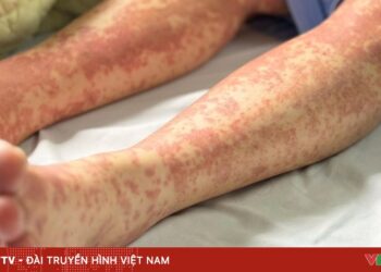 di ung thuoc bv nhiet oi 13 3 2025 89339629855748388061287 90165520563162778912359.jpg