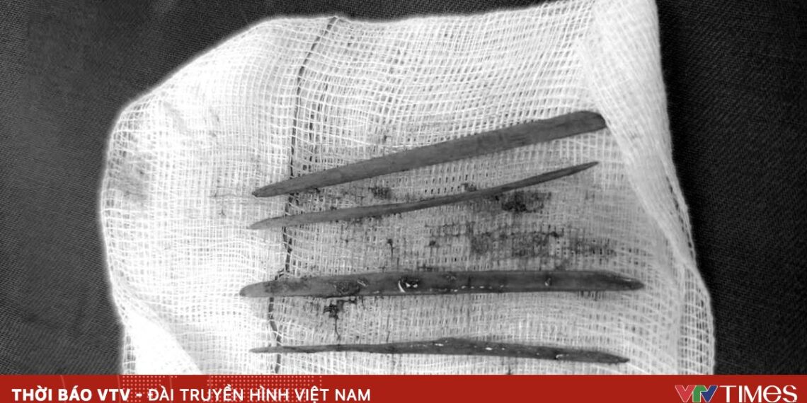 Nuốt 3 cây tăm, nữ bệnh nhân phải mổ cấp cứu nuot tam tre 14890062358599998313724 44224380771013041406766.jpg