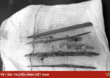 Nuốt 3 cây tăm, nữ bệnh nhân phải mổ cấp cứu nuot tam tre 14890062358599998313724 44224380771013041406766.jpg