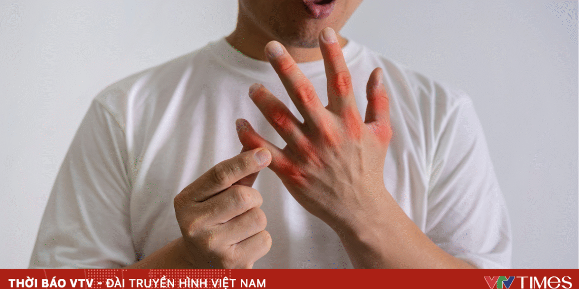 3 bệnh lý chuyển hóa thường gặp sau Tết package media 04969518875403476590209 59728105955129066767642.png