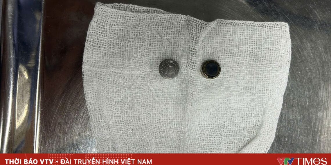 Cảnh báo trẻ nuốt dị vật nguy hiểm pin cuc ao 57429188272924257727734 39951120696750391441646.jpg