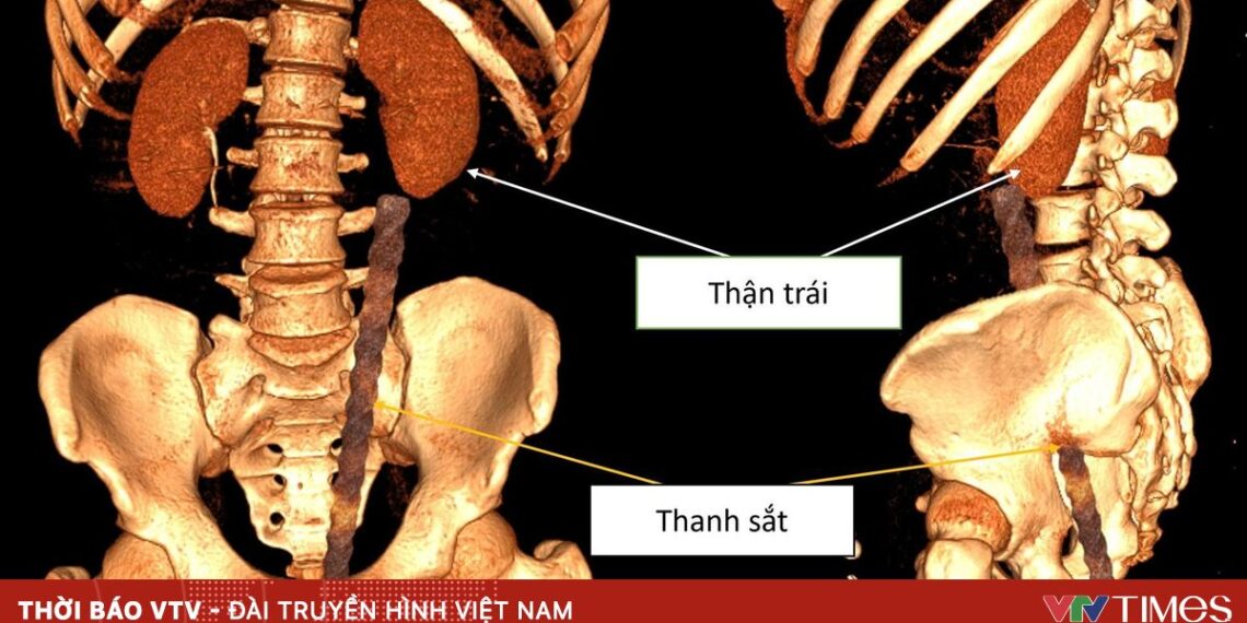 Dị vật xuyên thấu bụng do tai nạn hy hữu thanh sat 85847132509564024779458 17177072519798054151432.jpg