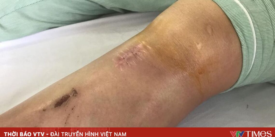 Dọn nhà đón Tết, phòng ngừa chấn thương khớp tiem khop 82720423225442410247529 78995547271344913480536.jpg