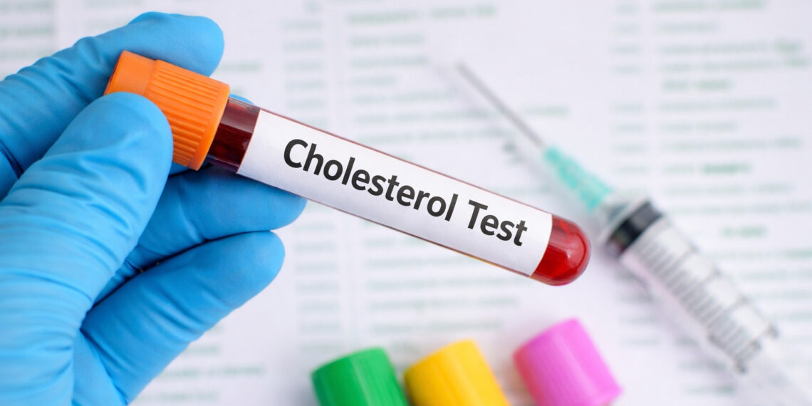 3 dấu hiệu ở mắt có thể cảnh báo mỡ máu cao từ sớm