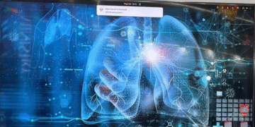 ai giup phat hien ung thu phoi giai doan rat som 607.png