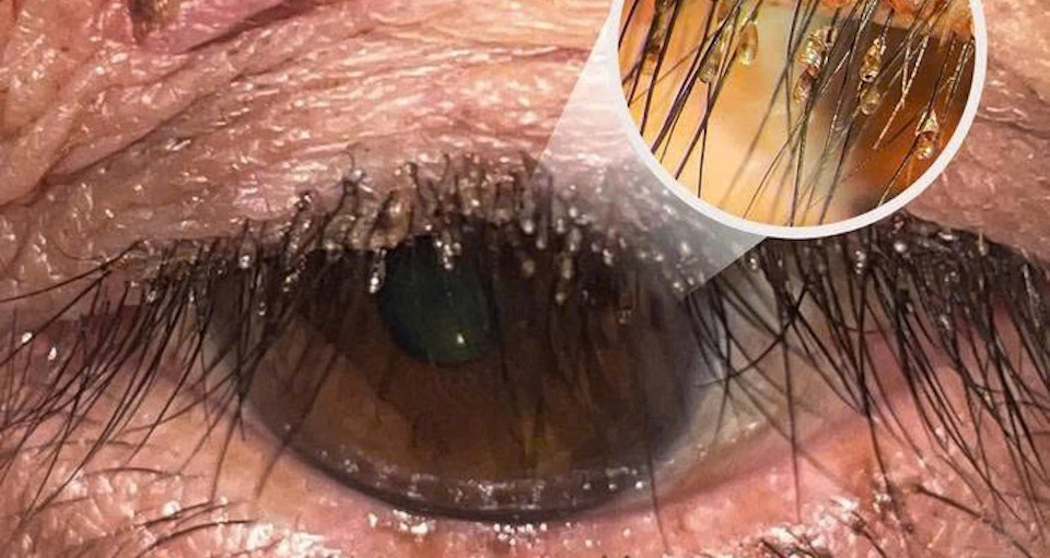 Bác sĩ bất ngờ về ổ rận mu bám chi chít trên lông mi người phụ nữ bac si bat ngo ve o ran mu bam chi chit tren long mi nguoi phu nu 1402.jpg