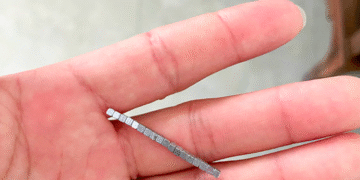 Hàng chục viên nam châm kết thành chuỗi gây thủng ruột bé trai 5 tuổi Hàng chục viên nam châm kết thành chuỗi gây thủng ruột bé trai 5 tuổi