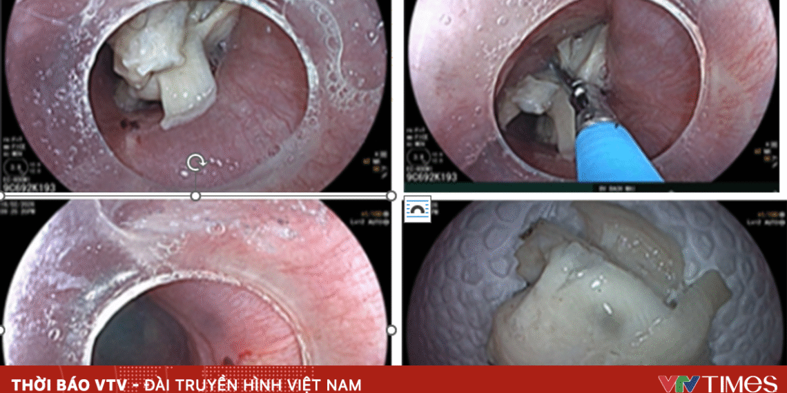 Liên tiếp 3 ca nuốt dị vật nguy hiểm dịp Tết hoc di vat 26214435274590874874954 18955627325738475410890.png