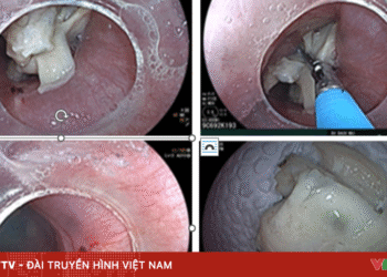 Liên tiếp 3 ca nuốt dị vật nguy hiểm dịp Tết hoc di vat 26214435274590874874954 18955627325738475410890.png