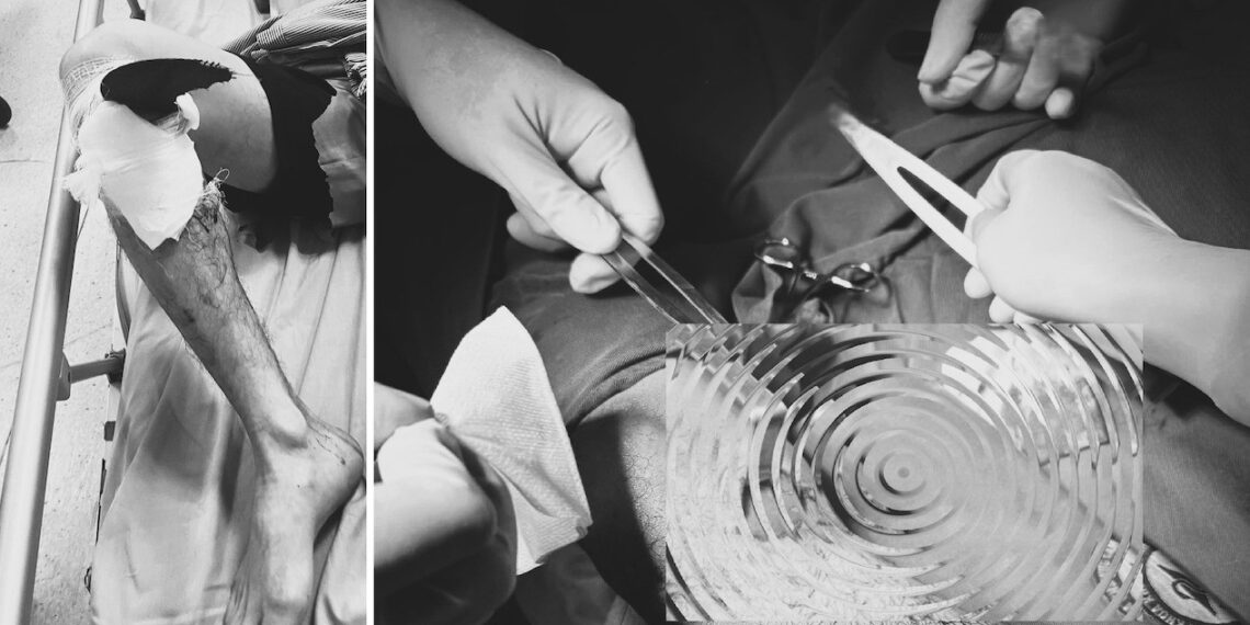 luoi may mai vang ra gam sau vao goi nguoi dan ong 43 tuoi 1816.jpg