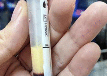 Tiệc tùng suốt tháng Tết, người đàn ông nhận xét nghiệm máu đục trắng như sữa tiec tung suot thang tet nguoi dan ong tre nhan xet nghiem mau duc trang nhu sua 2077.png