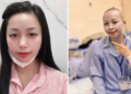 loi day dut cua nguoi phu nu tre bi ung thu di can giai doan 4 522.png