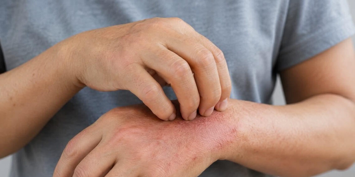 Ngứa ở 2 vị trí trên cơ thể có nguy cơ là biểu hiện xơ gan ngua o 2 vi tri tren co the co nguy co la bieu hien xo gan 3250.jpg